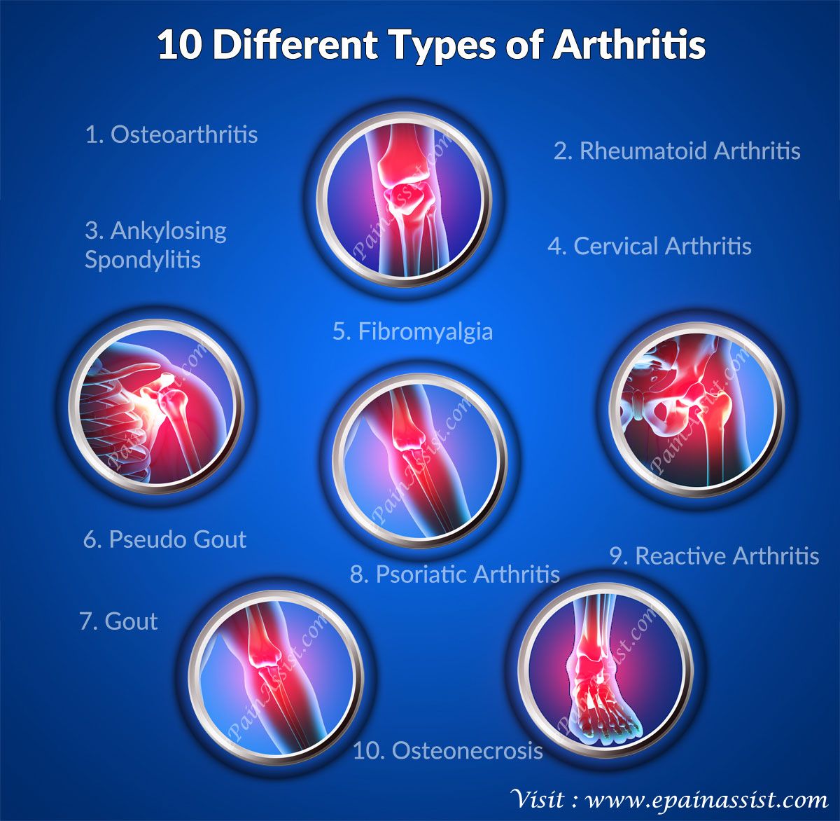 Rheumatoid arthritis stories what are the types of arthritis 