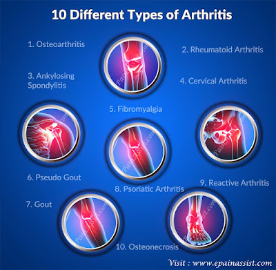 What Are the Types of Arthritis?