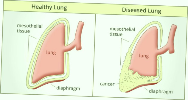 what are the final stages of emphysema