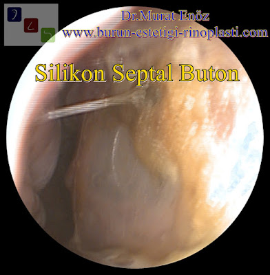 Silicone septal buttons for nasal septum perforation - Nasal septum perforation treatment in İstanbul - Nasal septal perforation and silicone buttons - Risks and complications of silicone septal buttons - Nasal septum perforation repair in Turkey