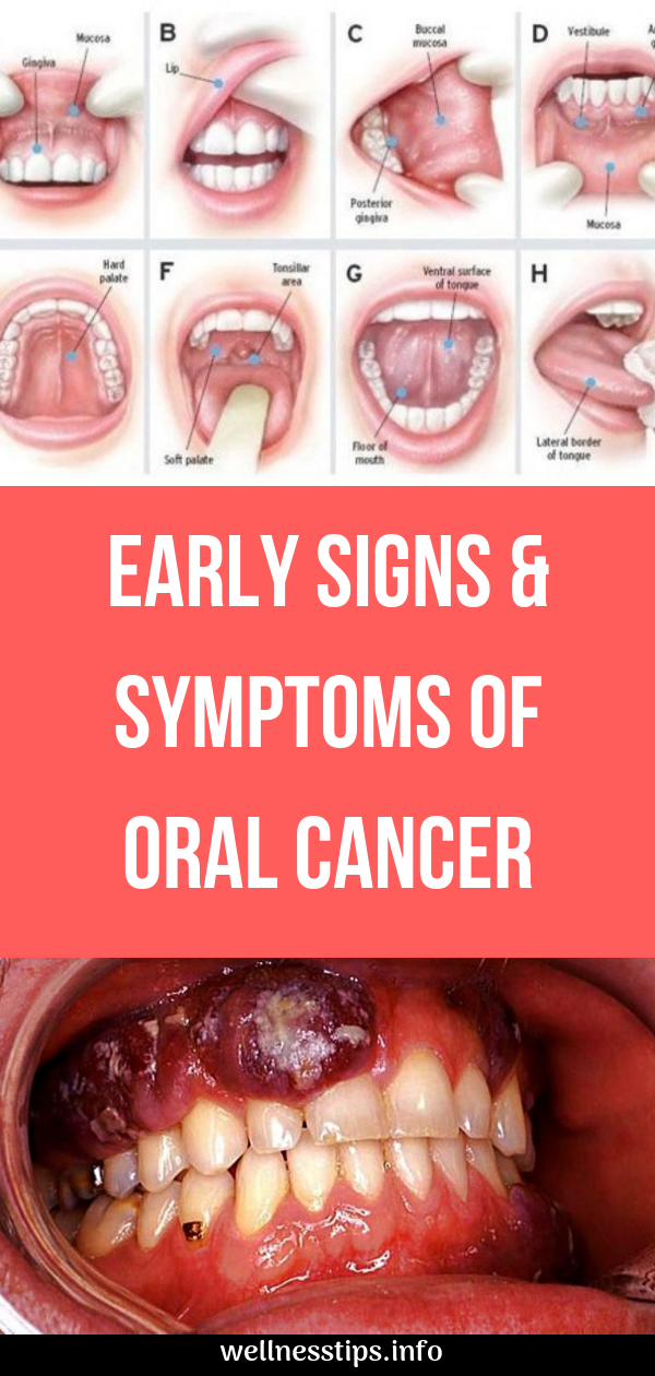 Early Signs & Symptoms of Oral Cancer Healthy Crops