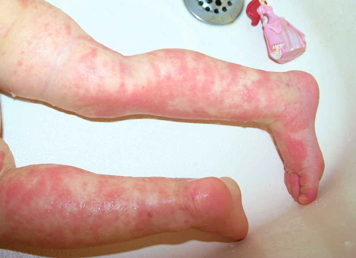Staphylococcal infections - NHS Choices