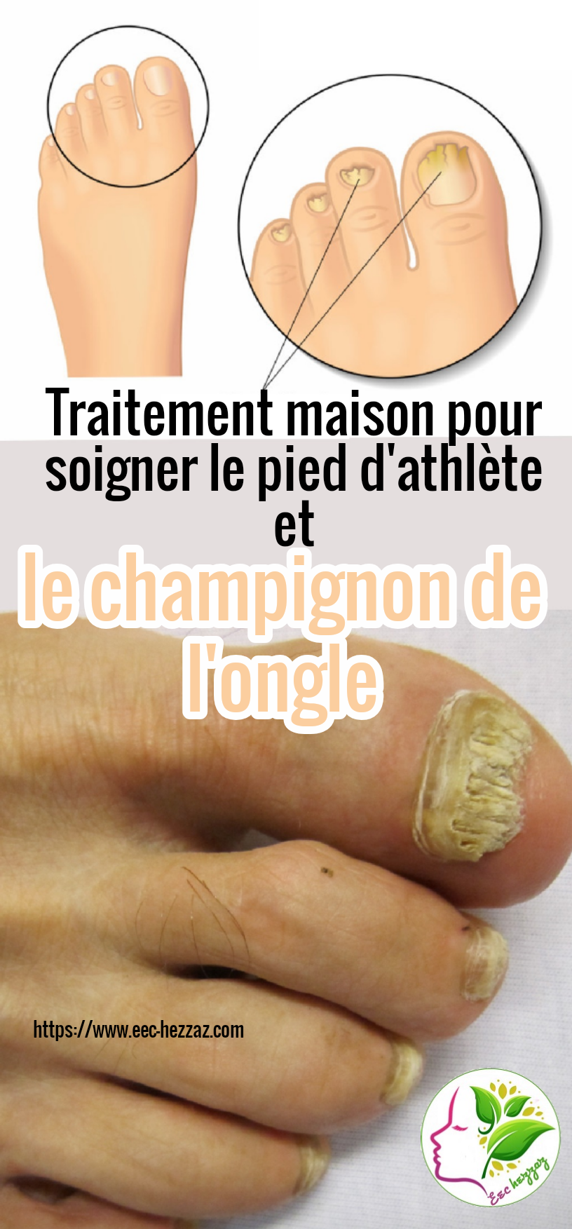 Traitement maison pour soigner le pied d'athlète et le champignon de l'ongle