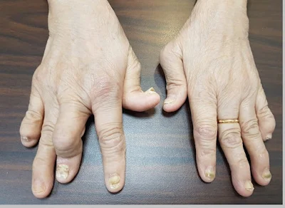 Artritis (kerusakan tulang rawan sendi) - berbagaireviews.com