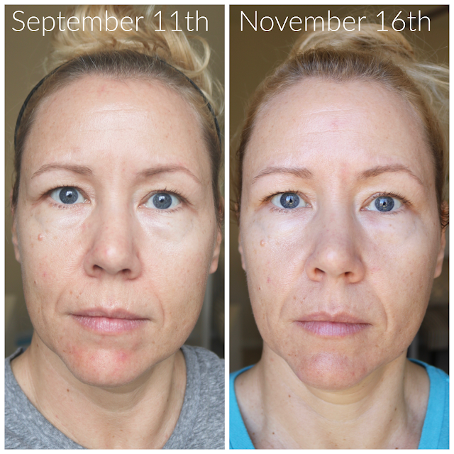 NuFACE before & after pics after 60 days!
