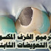 ترميم الخزف المكسور في التعويضات الثابتة ترميم الخزف المكسور في التعويضات الثابتة