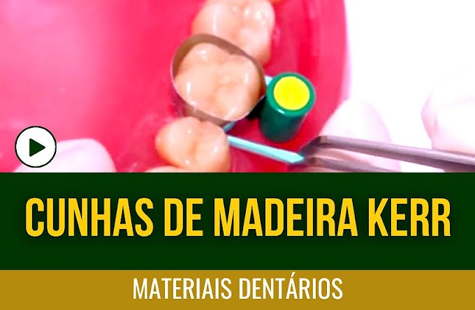 MATERIAIS DENTÁRIOS: Cunhas de Madeira Kerr