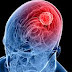 Brain Tumor & Their Symptoms and Treatments ****