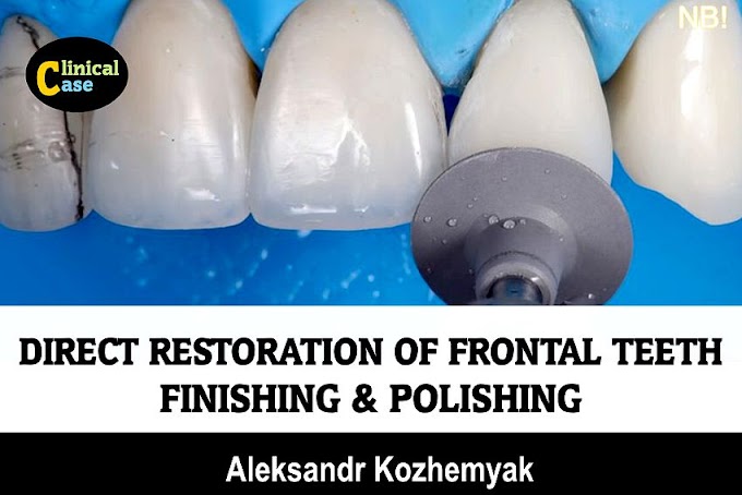 COMPOSITE RESTORATION: Direct restoration of frontal teeth - Finishing & Polishing - Aleksandr Kozhemyak