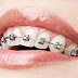 Niềng răng mắc cài kim loại có ưu điểm gì?