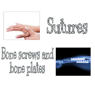 This image shows uses of biodegradable polymers in sutures,bone screws,bone plates.
