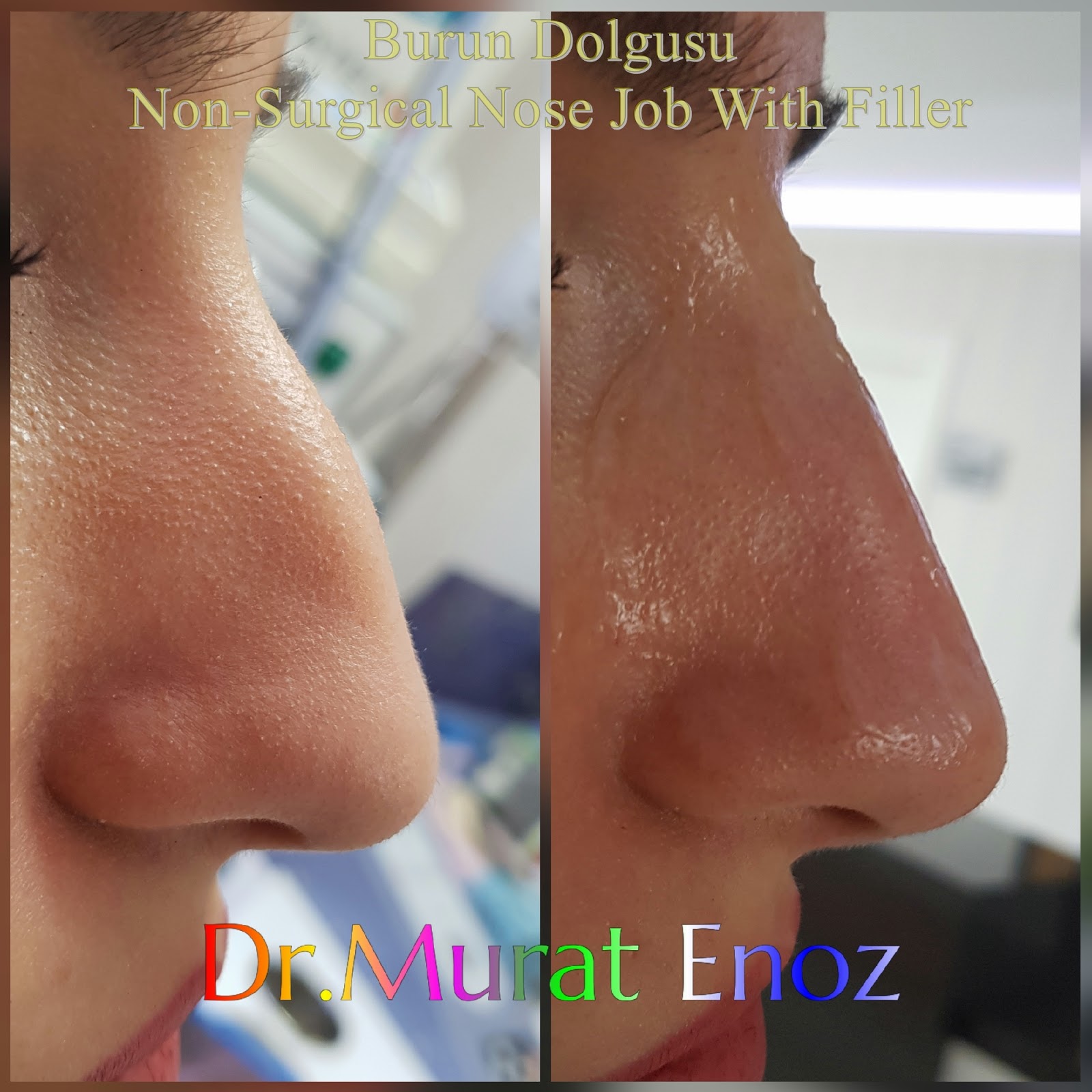 Alin Cizgilerine Dolgu Ankara Dr Buket Yildirim