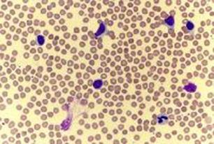Peripheral smear from a patient with chronic lymphocytic leukemia, large lymphocytic variety. Smudge cells are also observed