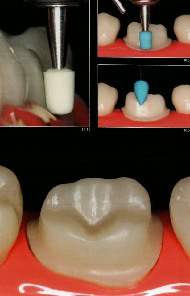 Posterior crown preparation Dental Esthetics