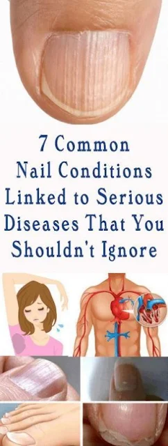 DO NOT IGNORE THESE NAIL CONDITIONS LINKED TO SERIOUS DISEASES - Health ...