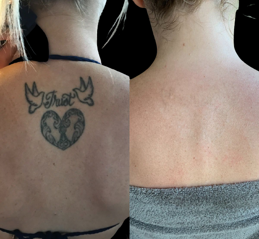 Laserless Tattoo Removal In Article Clipconverteronline - Blogging Hindi Tips News Biography