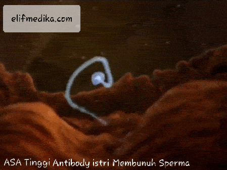 Alergi Sperma (ASA Tinggi) : Antibody istri menyerang sperma Alergi Sperma (ASA Tinggi) : Antibody istri menyerang sperma