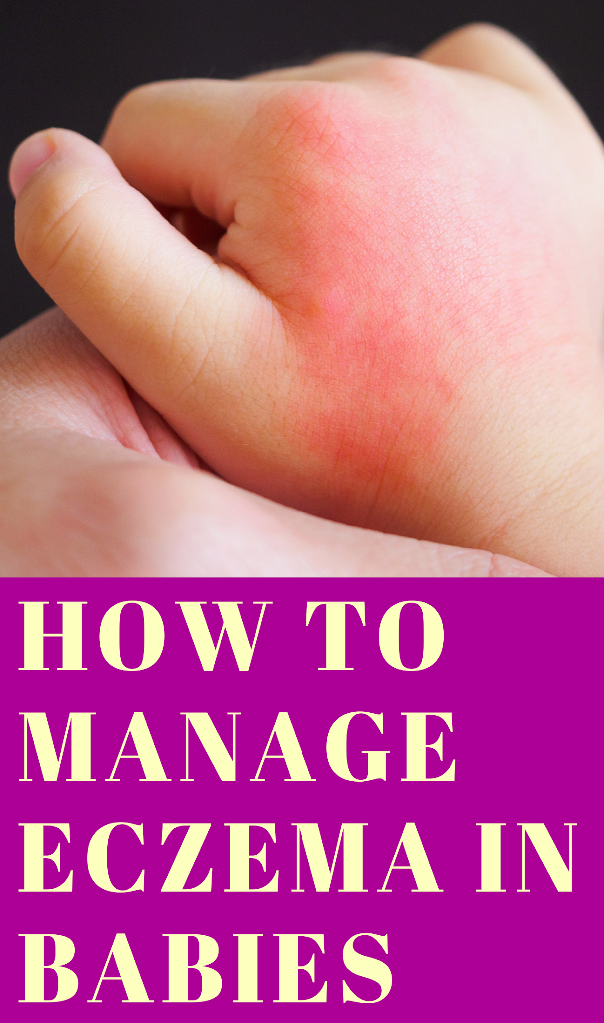 Eczema in Babies How to Treat Them How to manage eczema in babies
