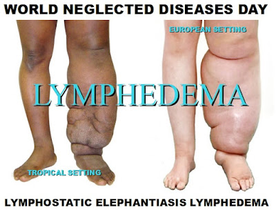 Asociacion Galega De Linfedema Lipedema Insuficiencia Venosa