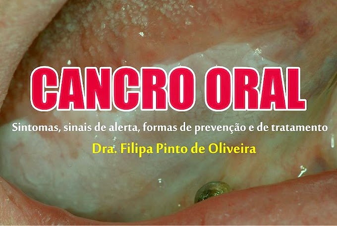 CANCRO ORAL: Sintomas, sinais de alerta, formas de prevenção e de tratamento - Dra. Filipa Pinto de Oliveira
