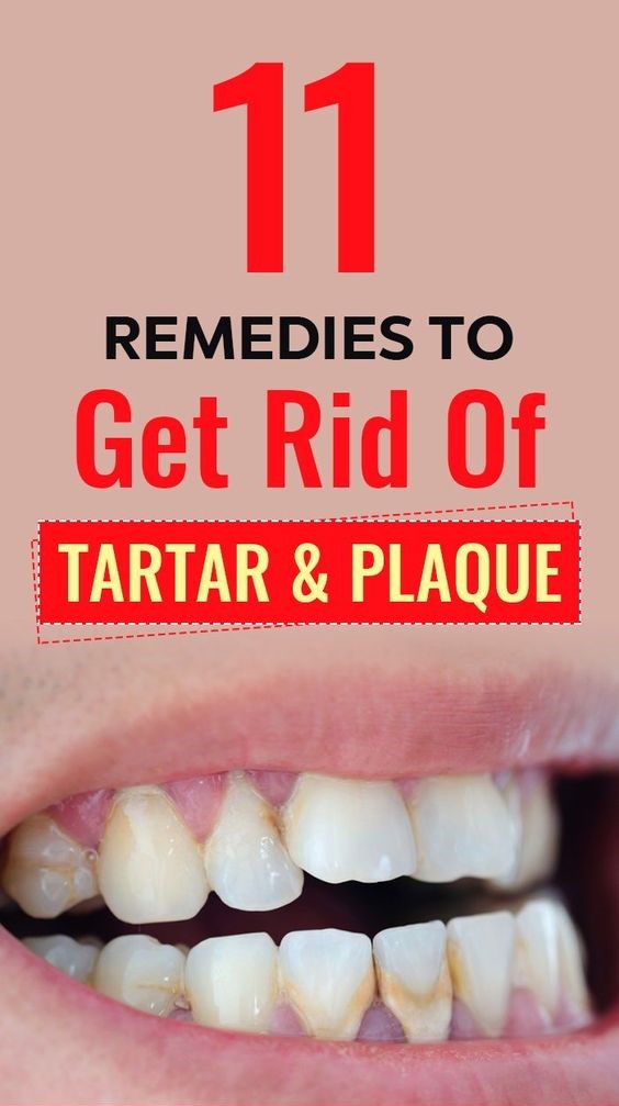 11-home-remedies-to-get-rid-of-tartar-and-plaque-on-teeth-wellness-topic