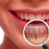 Cấy ghép răng implant giá khoảng bao nhiêu tiền ?