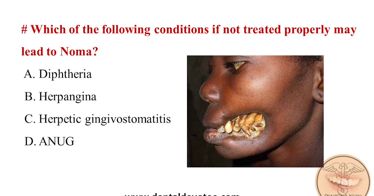 Dentosphere World of Dentistry Condition which may lead to Noma