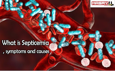 ما هو تسمم الدم وماهي اعراضه واسبابه What is Septicemia , symptoms and causes blood poisoning
