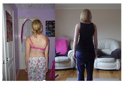 my back before and after scoliosis surgery