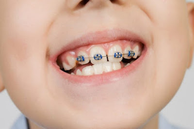 Quy trình niềng răng trẻ em đạt chuẩn