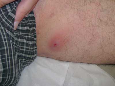 Fast Hidradenitis Suppurativa Cure