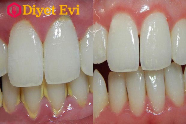 Diş tartarı evde nasıl temizlenir Pratik Tarifim