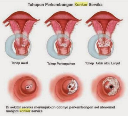 obat alami tumor serviks, obat kanker serviks, pengobatan kanker serviks