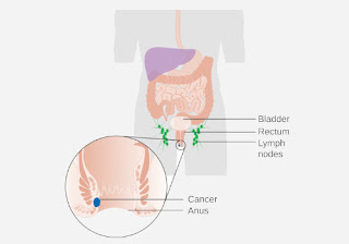 Signs and Symptoms of Anal Cancer