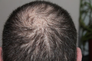 penyebab rambut rontok penyebab rambut rontok