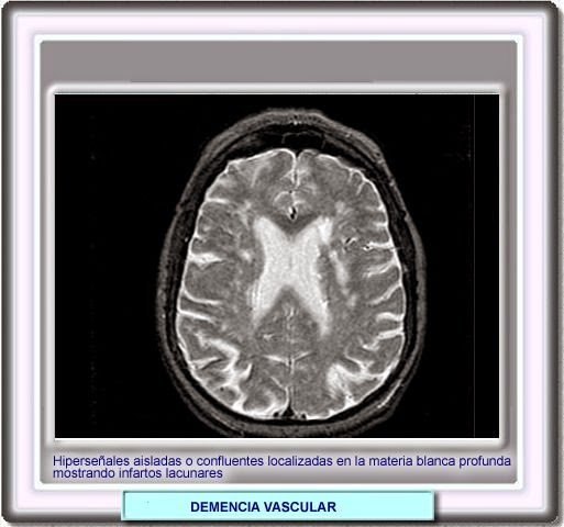 EPÓNIMOS ENFERMEDAD DE BINSWANGER