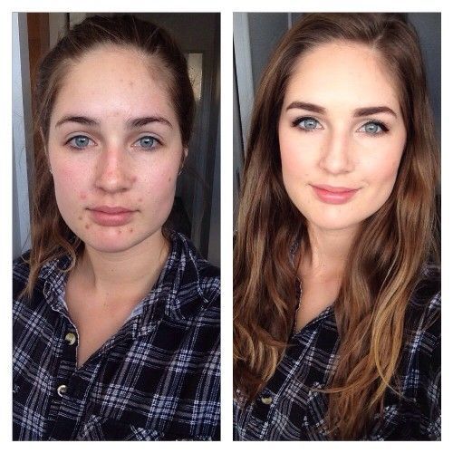 Insane Akne Transformationen, Die Beweisen, Dass Die Macht Von Make-Up - neumode