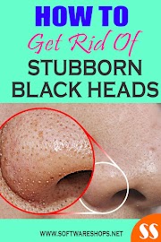 How to get rid of stubborn blackheads