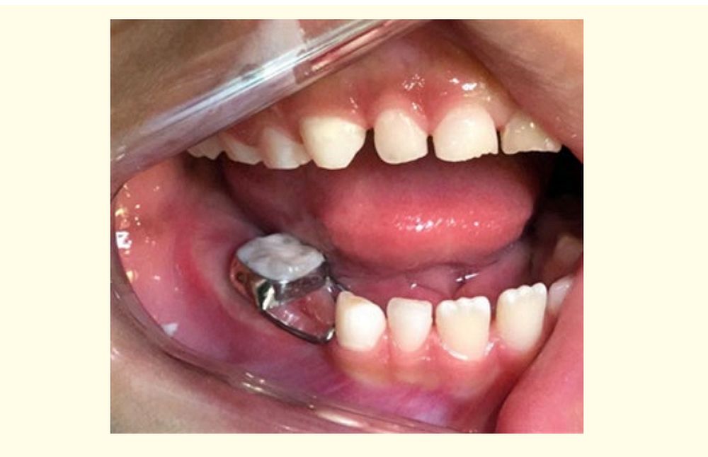 Space Maintainers Get Images