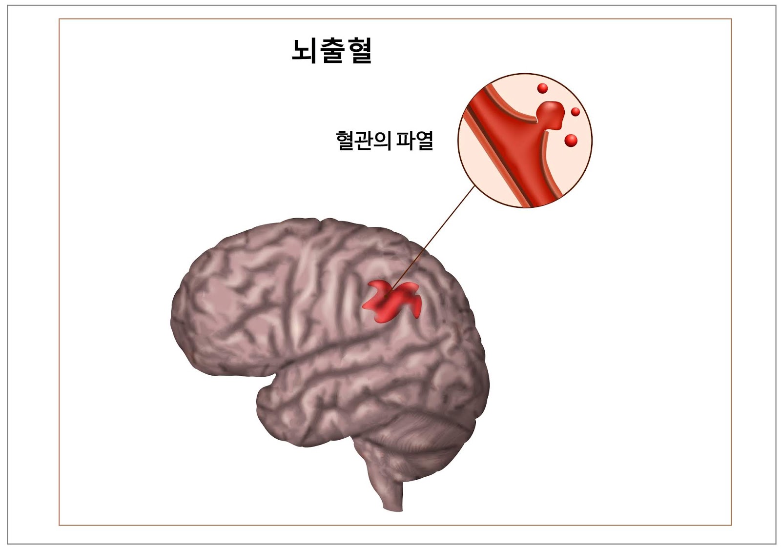 [뇌졸중] '해면상 혈관종'에 해당하지만 뇌출혈 소견도 인정해 '뇌졸중' 진단 인정 사례(항소심)