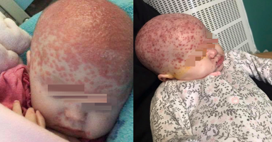 Six-month-old baby infected with herpes disease from a ...