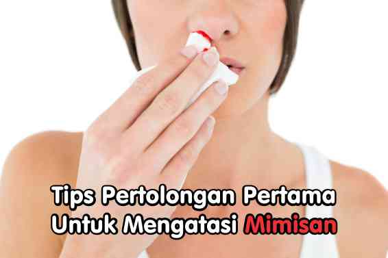 Tips Pertolongan Pertama Untuk Mengatasi Mimisan - Mimisan merupakan keluarnya darah dari hidung, baik dari salah satu atau kedua lubang hidung. Mimisan ini bisa terjadi selama hitungan detik hingga hitungan menit. Mimisan mungkin pernah dialami oleh sebagian orang.