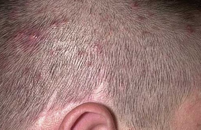 Acne On Hairline