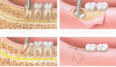 Cách xử lý sưng nướu răng trong cùng