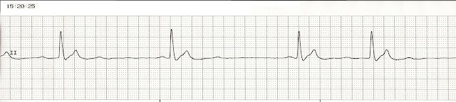 Pea Rythm Monitor Megacode PEA Part 1