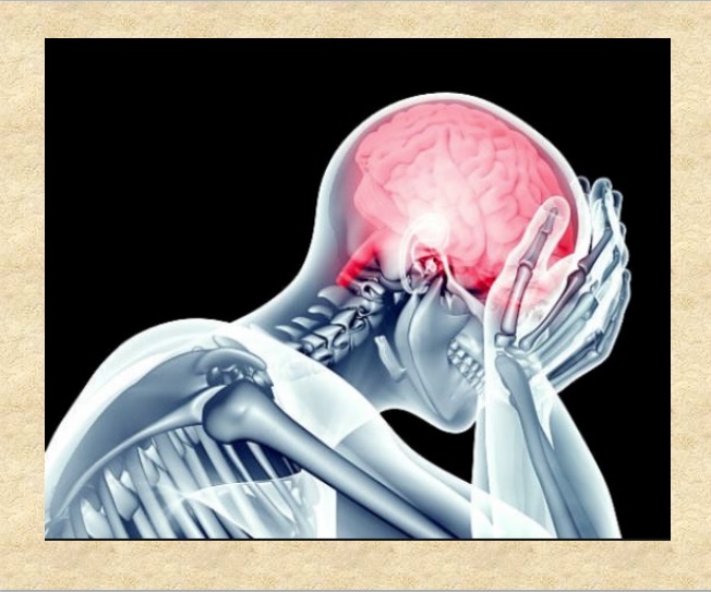 Principales causas de un infarto cerebral