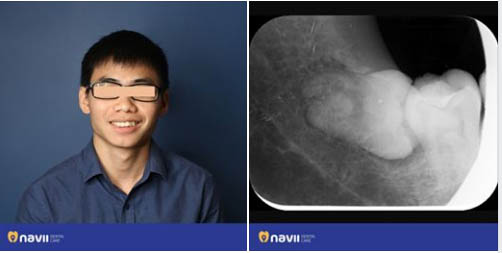 Nhổ răng số 8 có nguy hiểm không