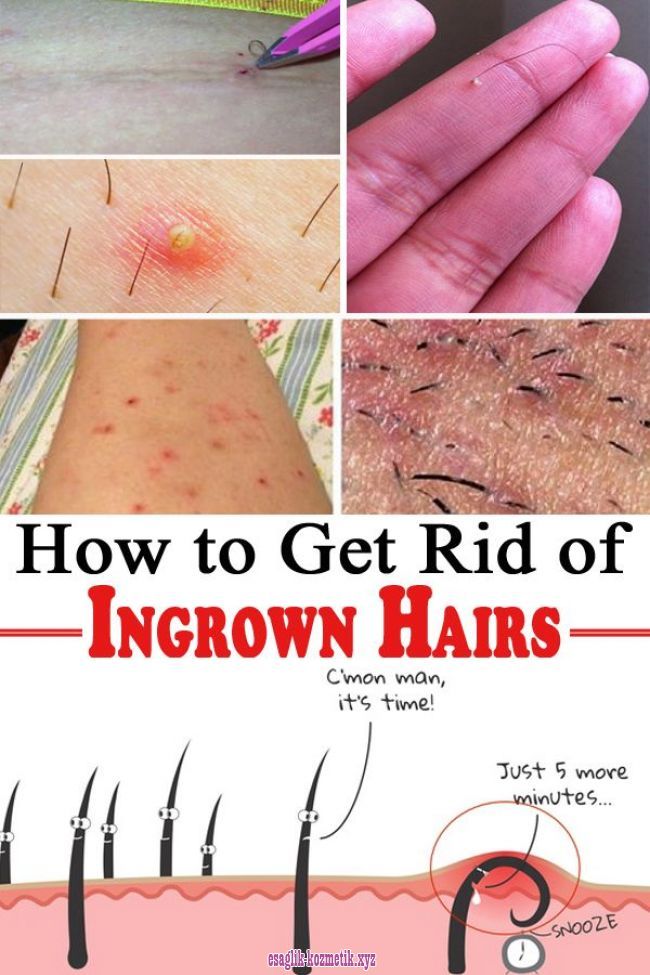 How To Get Rid Of Ingrown Hairs Healthy Safely