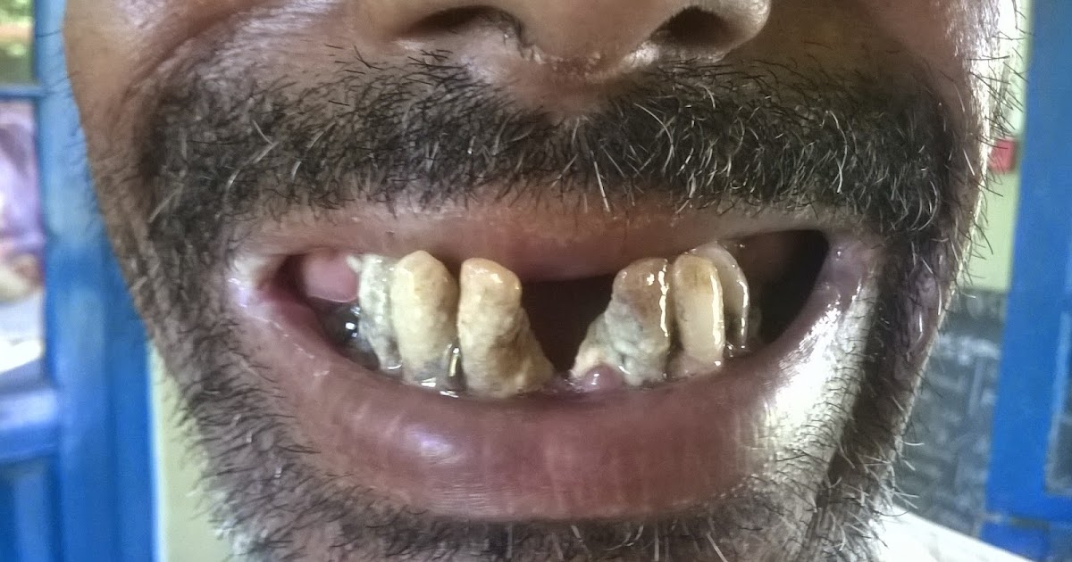 Oral Ulcer (Mouth Sore) Causes, Symptoms, Danger Signs, Healthy Tips