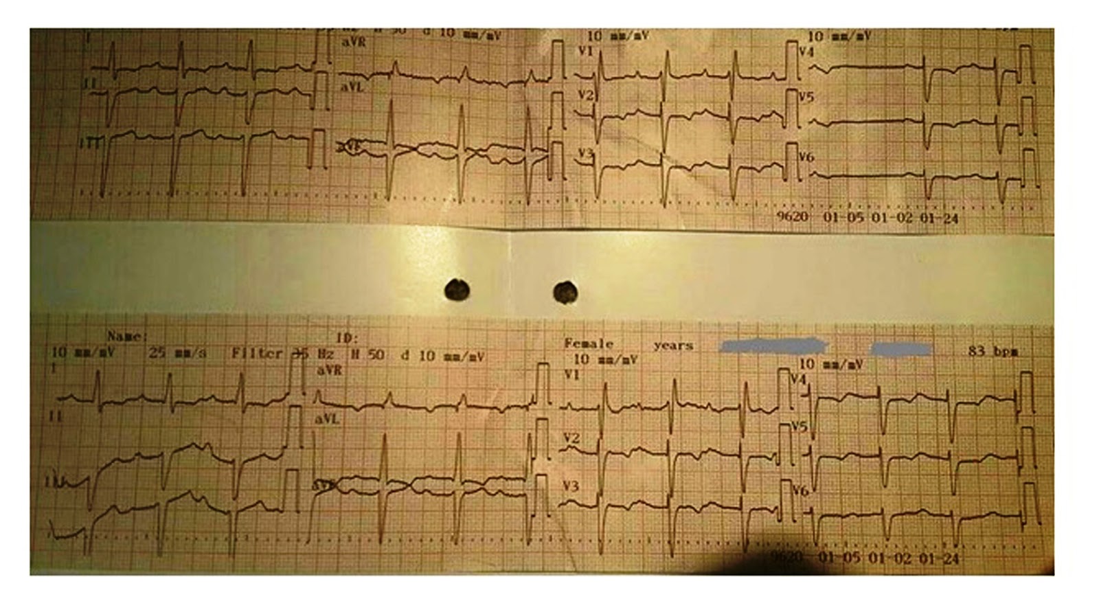 ECG Rhythms A case of trifascicular Block by Dr. Tính Nguyễn Chí